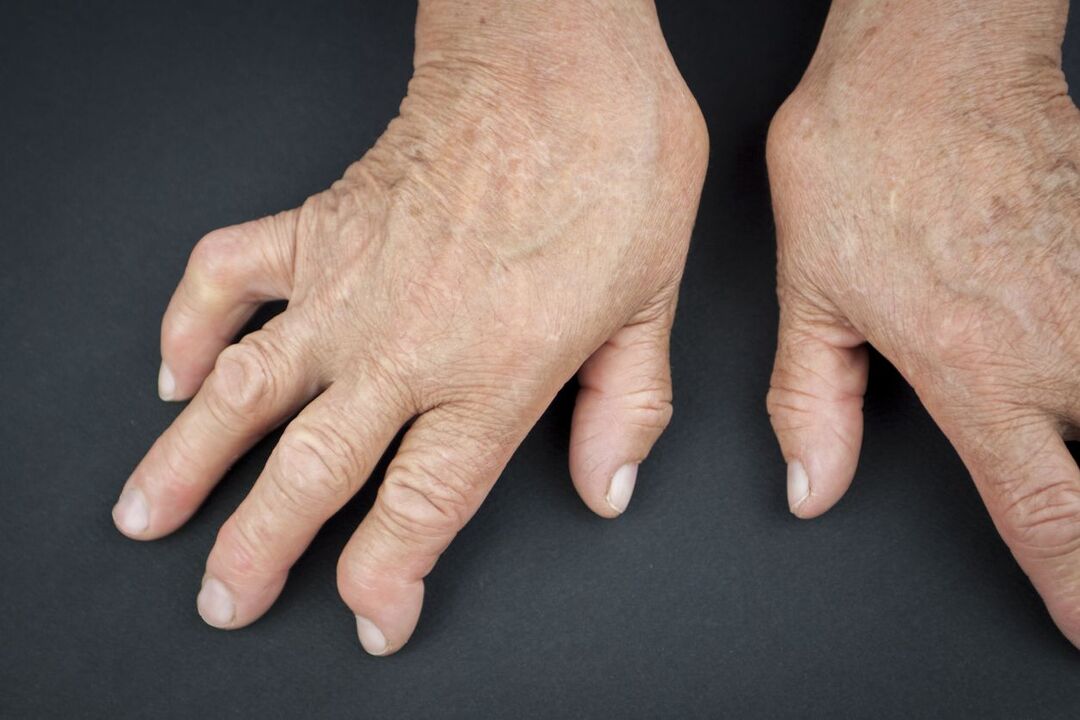 gout on the hands