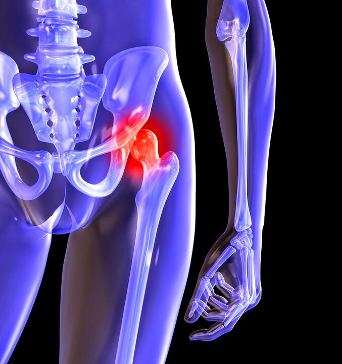 Summarize the arthrosis of the hip joint