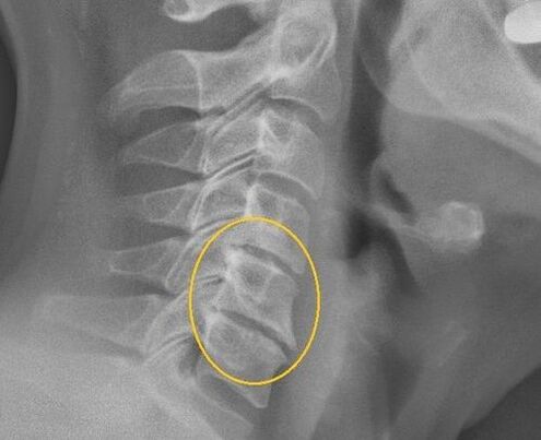 Cervical spinal osteochondrosis on x -ray