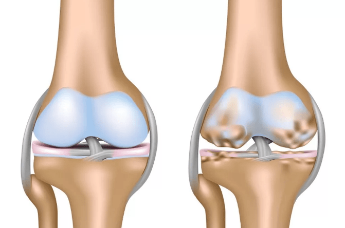 Summarize the arthrosis of the knee joint