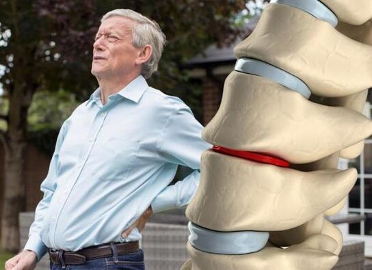 Osteochondrosis affects the intervertebral disc and causes back pain